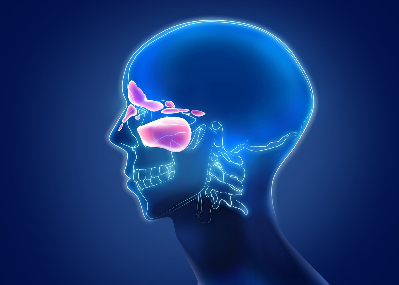 -Ray Picture of Man Showing Progressing Sinusitis in Nasal Cavities on Blue Background, Illustration